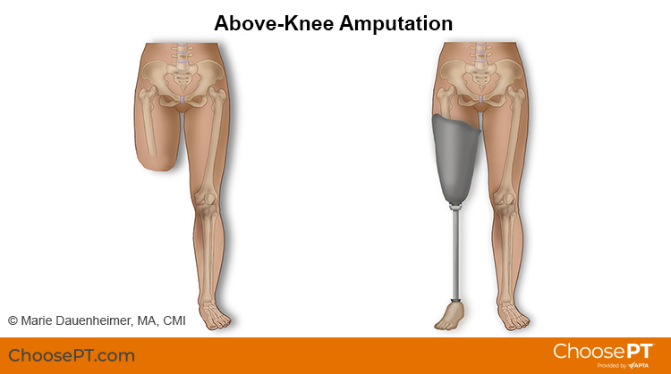 Endoskeletal above knee prosthesis for above knee amputee