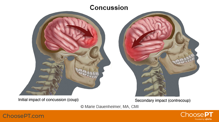 what happens if you drive with a concussion