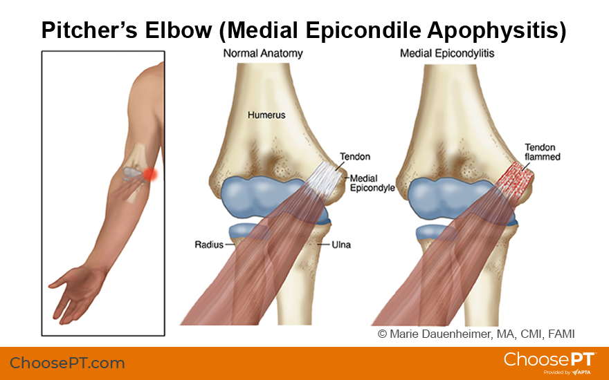 Illustration of pitcher's elbow (medial epicondylitis)