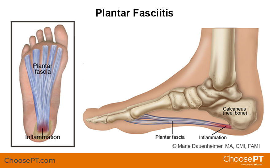 Guide, Physical Therapy Guide to Plantar Fasciitis