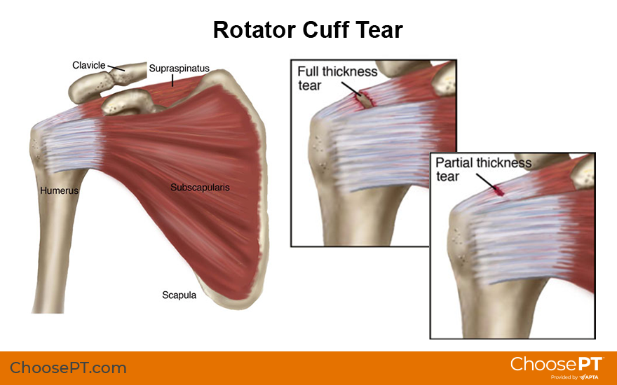 Illustration of rotator cuff tears