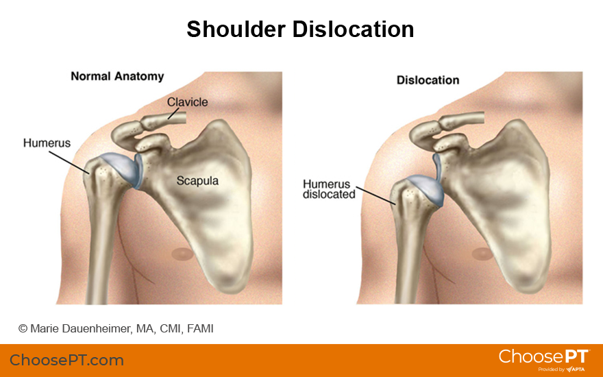 Illustration of shoulder dislocation