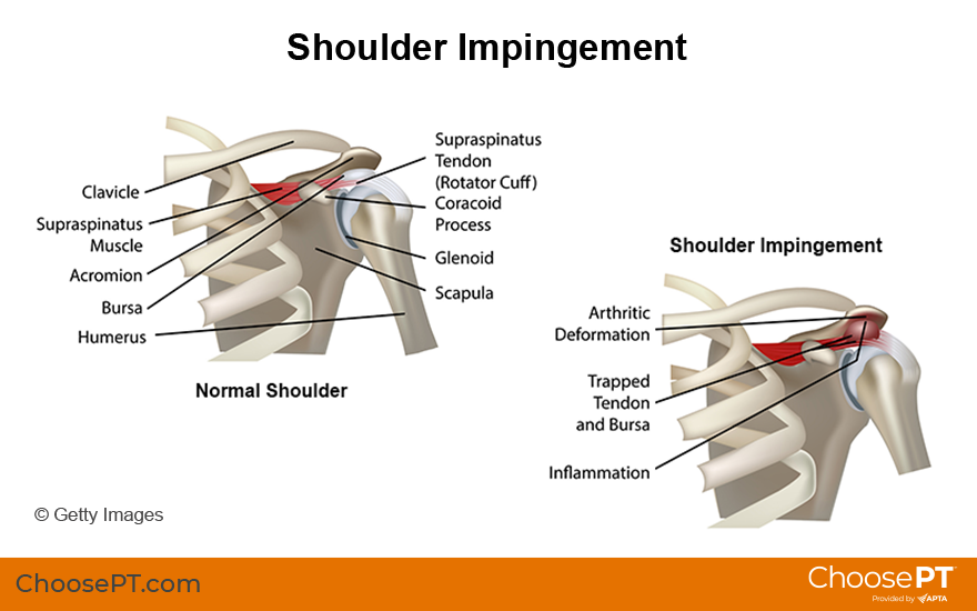 shoulder impingement diagnosis