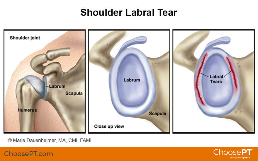 Illustration of shoulder labral tear