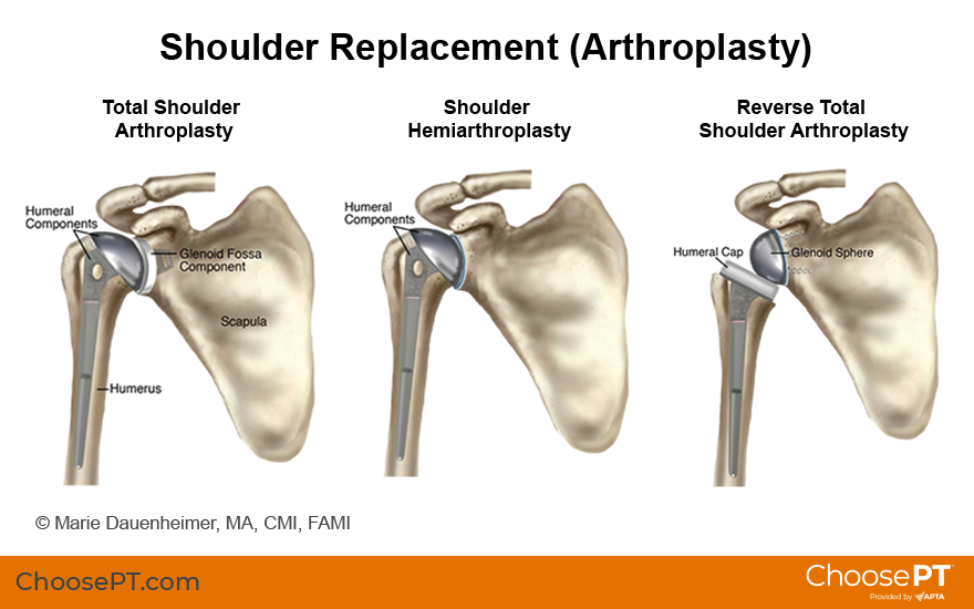 Guide  Physical Therapy Guide to Total Hip Replacement