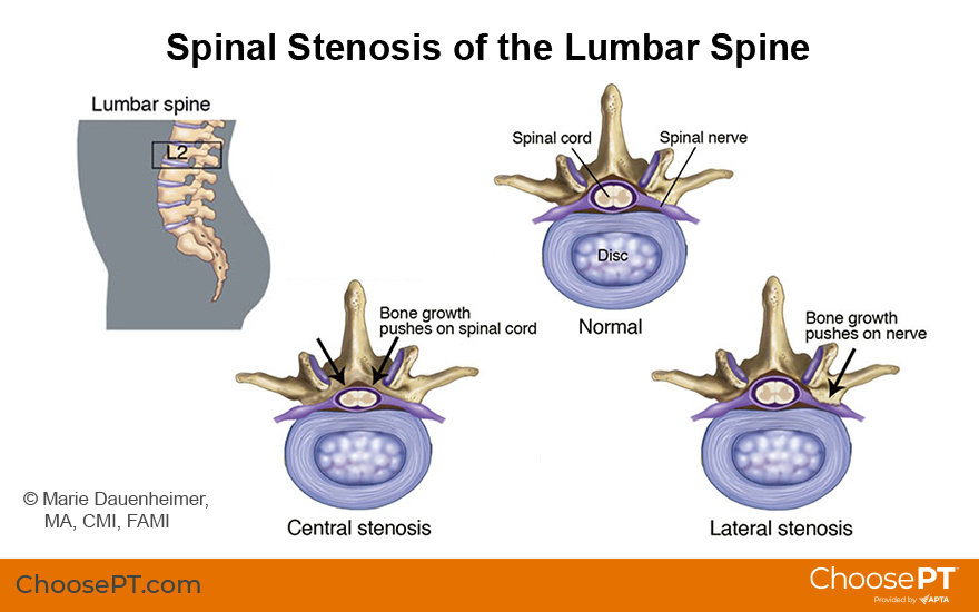 Illustration of spinal stenosis