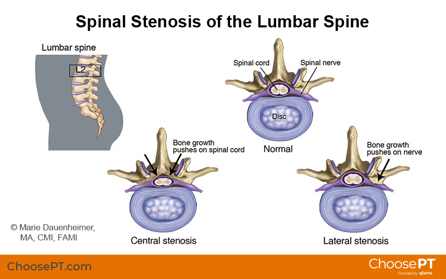 Spinal Stenosis Treatment Options - Advanced Wellness Solutions