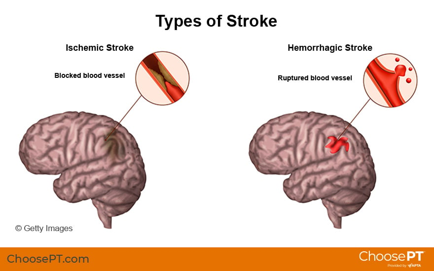 Illustration of Types of Stroke