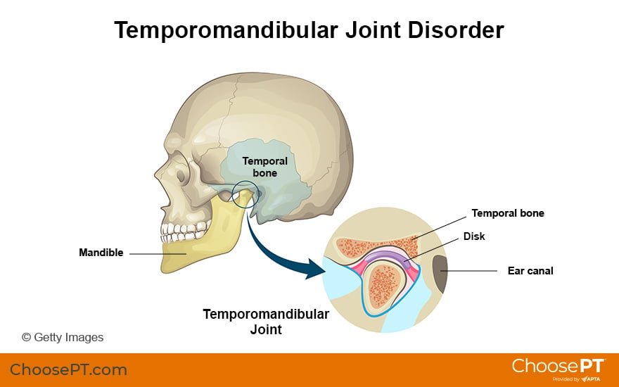 Illustration of Temporomandibular  Joint Disorder