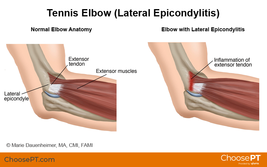 Illustration of tennis elbow (lateral epicondylitis)
