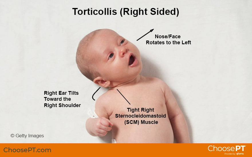 Illustration of Infant Torticollis