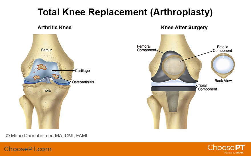 Occupational Therapy After Total Knee Replacement At Stanley Harrison Blog