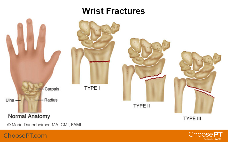 How Hand Fractures are Diagnosed and Treated