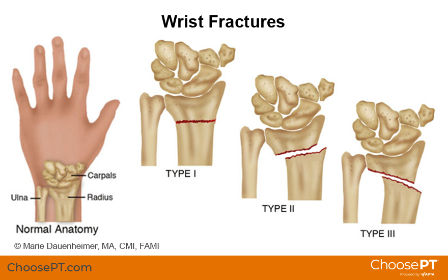 Colles Fracture Causes Symptoms And Diagnosis 51 OFF