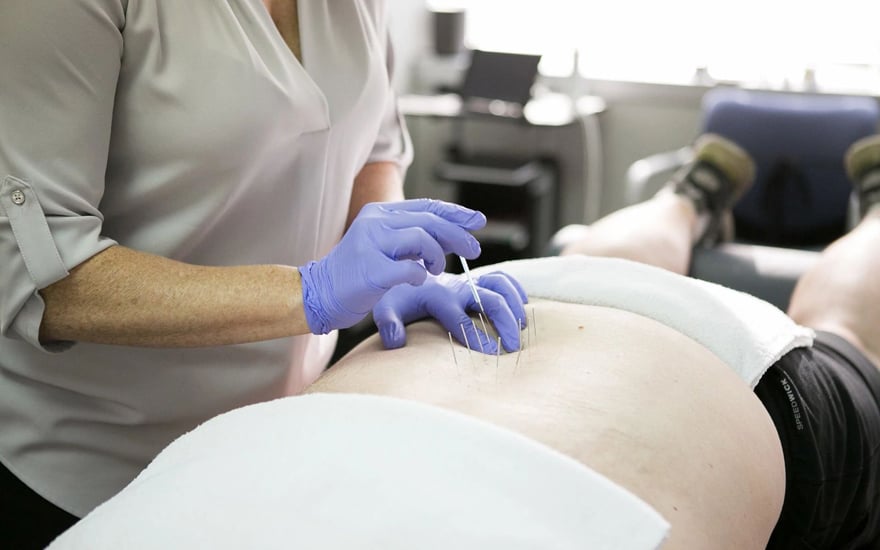 A physical therapist performs dry needling on a patient's lower back.