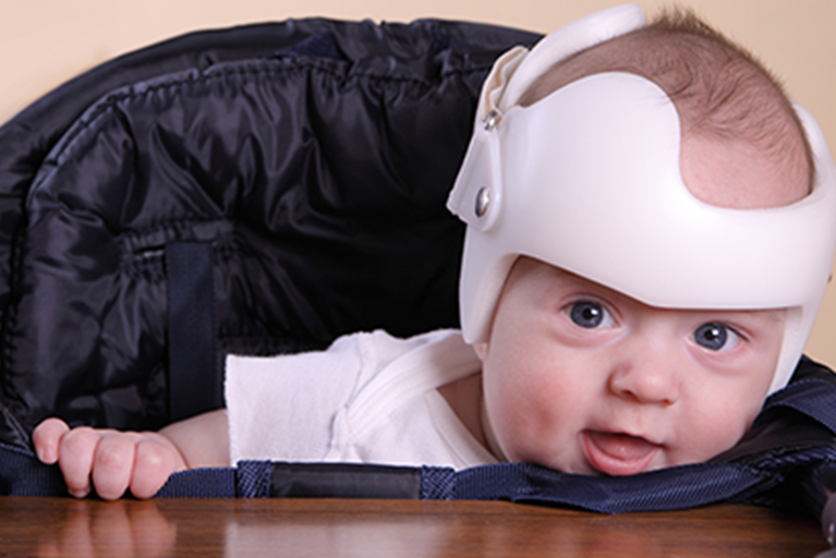 A baby with a cranial orthotic to improve head shape flatness.