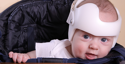 A baby with a cranial orthotic to improve head shape flatness.