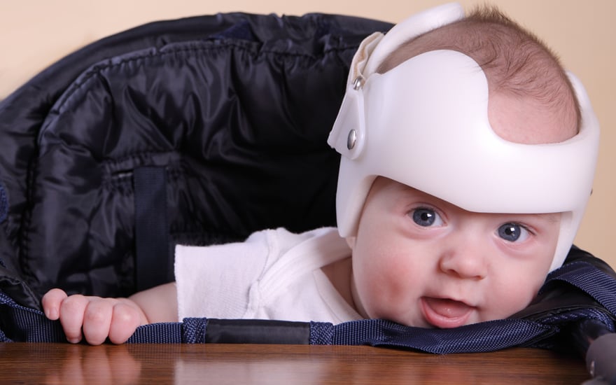 A baby with a cranial orthotic to improve head shape flatness.